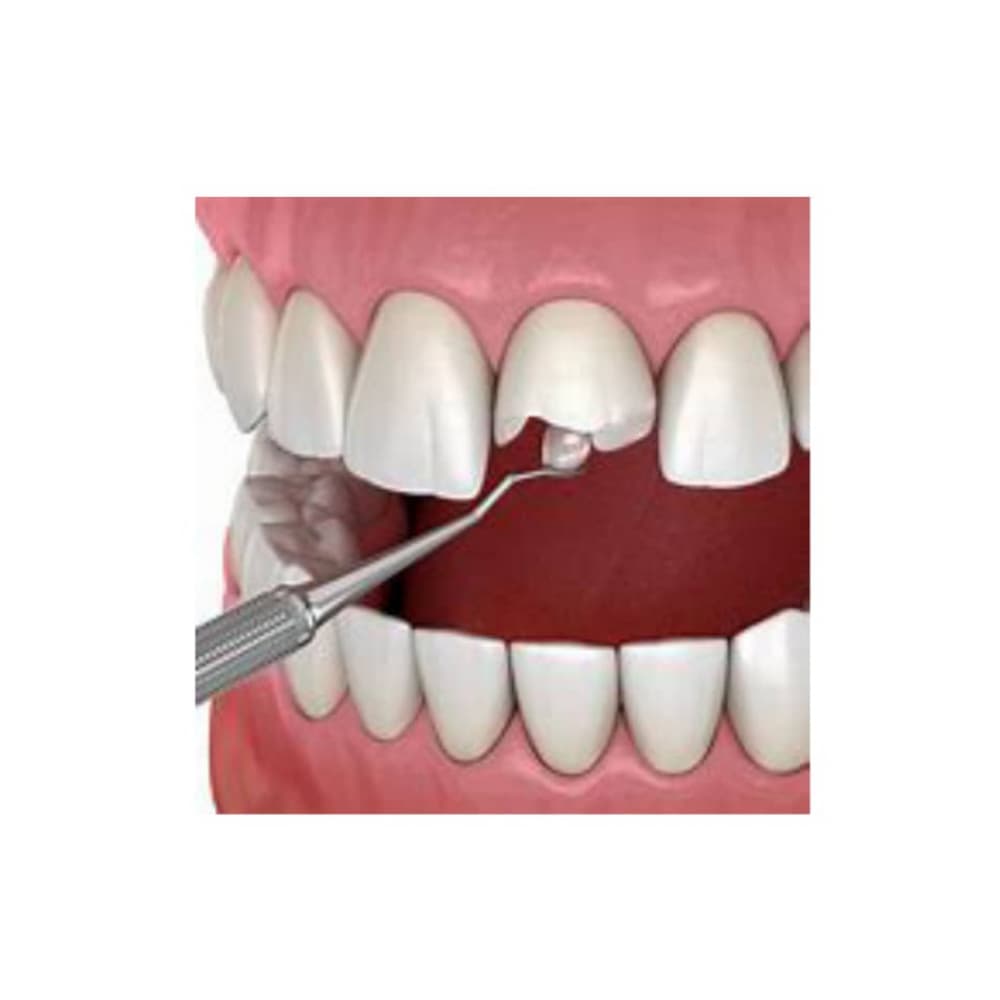 Kit de resina nanotecnológica para restauración dental. Color A3 - Miniatura 3